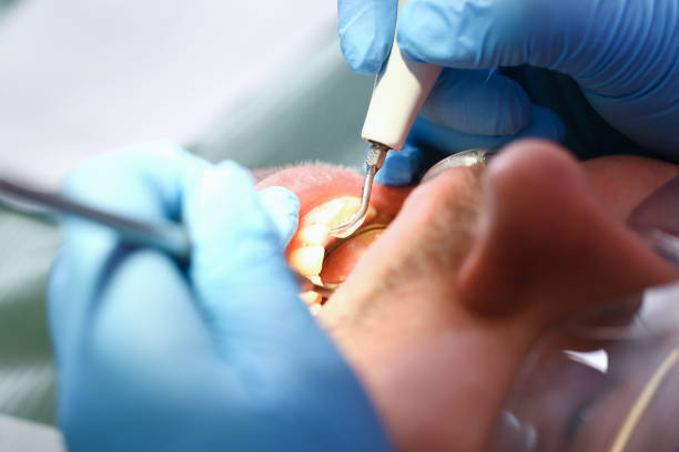 Best Emergency Dentist for Knocked-Out Tooth in Spring Valley Lake, CA