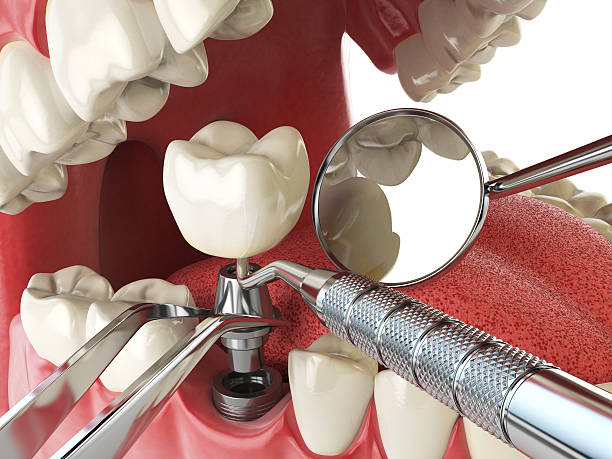 Best Emergency Dentist for Knocked-Out Tooth in Spring Valley Lake, CA